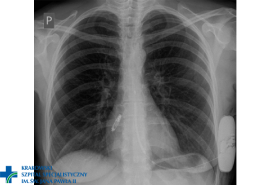 Opis pierwszego w Europie zabiegu połączenia bezelektrodowoego przedsionkowego stymulatora serca z podskórnym kardiowerterem defibrylatorem. Szpital JP2 Kraków