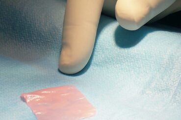 Własne komórki z nosa mogą pomóc w leczeniu chorego kolana. Szpital Żeromski Kraków